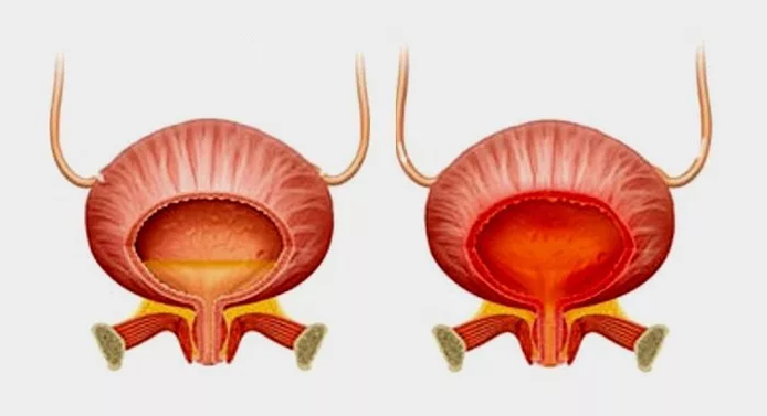 Normal bladder (left) and bladder inflammation with cystitis (right)